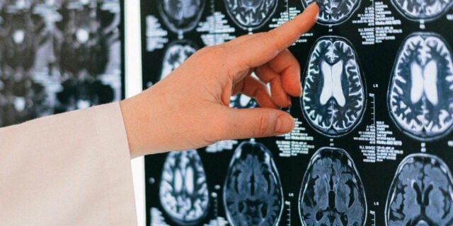 ### Descoperirea revoluționară a cercetătorilor australieni în lupta împotriva Alzheimerului