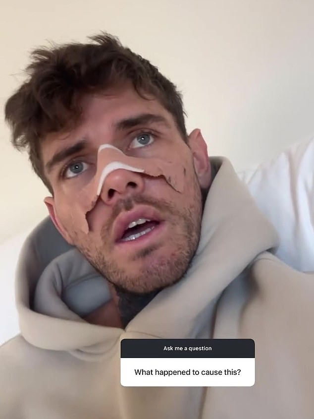 Addressing speculation head-on, the Melbourne-based entrepreneur recently explained the reason behind the surgery during an honest Instagram Q&A, after fans bombarded him with questions about his nose